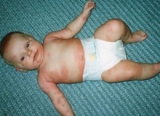 Bệnh xuất huyết giảm tiểu cầu: dấu hiệu, nguyên nhân Bệnh xuất huyết giảm tiểu cầu: dấu hiệu, nguyên nhân