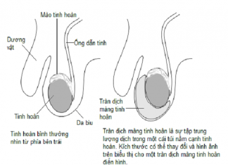 Nguyên nhân tràn dịch màng tinh hoàn ở nam giới? Tràn dịch màng tinh hoàn là gì?