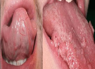 Biểu hiện sùi mào gà ở miệng và cách chữa trị Biểu hiện của bệnh sùi mào gà ở miệng