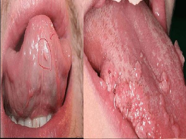 Biểu hiện của bệnh sùi mào gà ở miệng