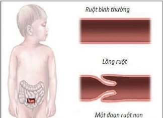 Bệnh lồng ruột ở trẻ cần phát hiện sớm để chữa trị? Bệnh lồng ruột ở trẻ cần phát hiện sớm để chữa trị?