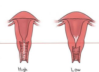 Thế nào là cổ tử cung ngắn, cách điều trị ra sao? Cổ tử cung ngắn là như thế nào?