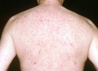 Bạn cần biết về bệnh ung thư da? Nguyên nhân, biểu hiện? ung thư da là gì