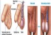 Giãn tĩnh mạch tinh hoàn là gì? Nguyên nhân mắc bệnh cơ bản Giãn tĩnh mạch tinh hoàn là gì?