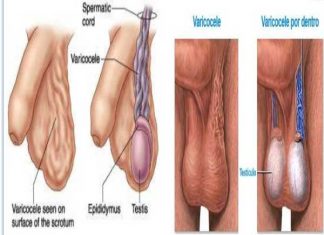 Giãn tĩnh mạch tinh hoàn là gì?
