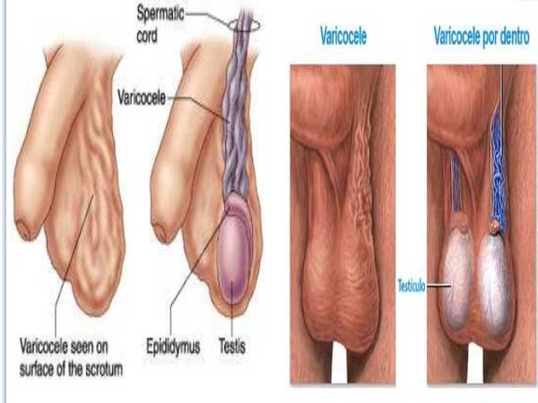 Giãn tĩnh mạch tinh hoàn là gì?
