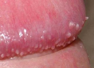 Nổi mụn trắng ở quy đầu và bao quy đầu cảnh báo bệnh gì?