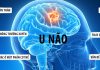 Phát Hiện U Não Từ Dấu Hiệu Đau Đầu, Nghe Kém: Hành Trình Chữa Trị và Cách Phòng Ngừa Phát Hiện U Não Từ Dấu Hiệu Đau Đầu, Nghe Kém: Hành Trình Chữa Trị và Cách Phòng Ngừa