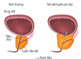 Người bị phì đại tuyến tiền liệt có nên quan hệ không? phì đại tuyến tiền liệt có nên quan hệ
