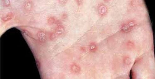 Giang mai dễ bị khi quan hệ bằng miệng