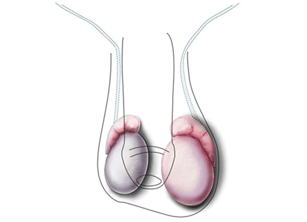Teo tinh hoàn là gì