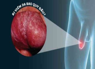 Giảm viêm bao quy đầu tại nhà với cách chữa trị đơn giản trị viêm bao quy đầu tại nhà