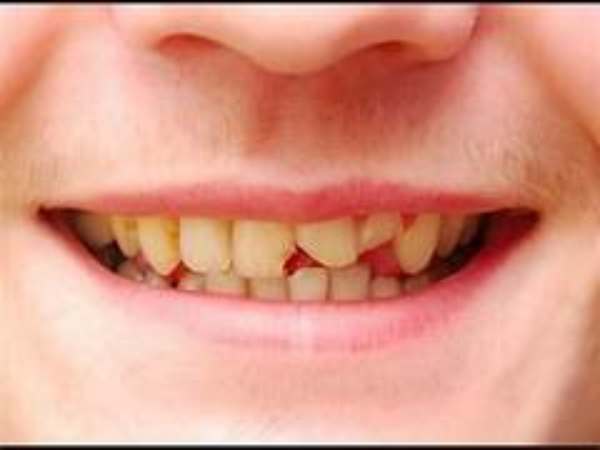 Mẻ răng dưới góc nhìn khoa học Mẻ răng dưới góc nhìn khoa học