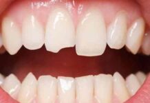 mẻ răng là điềm gì